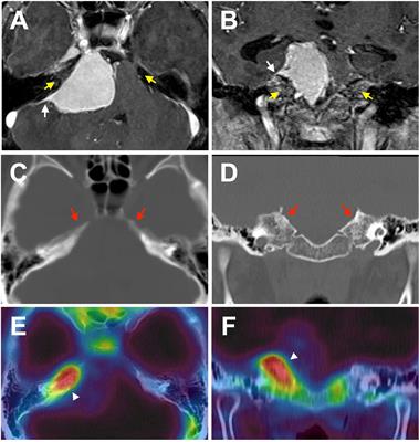 Bone Invasive Meningioma: Recent Advances and Therapeutic Perspectives